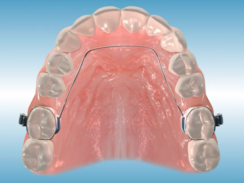 Lingual Arch