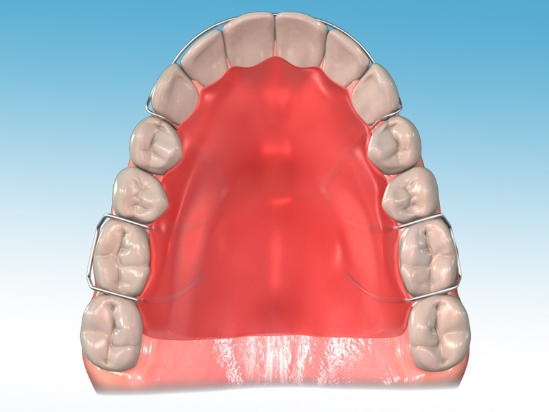 Removable Retainer