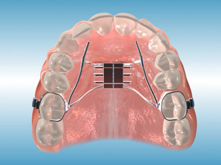 Palatal Expander