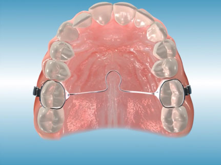 Transpalatal Bar