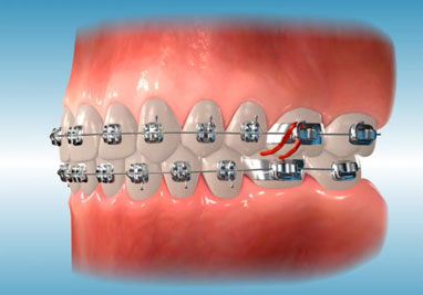 Buccal Tube