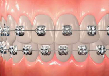 Types of Braces (Fixed Appliances)