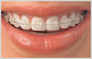 Ceramic braces