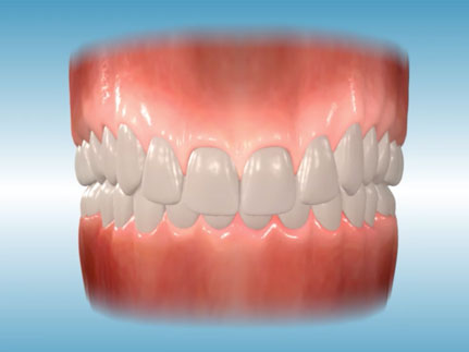 Incisor Overbite