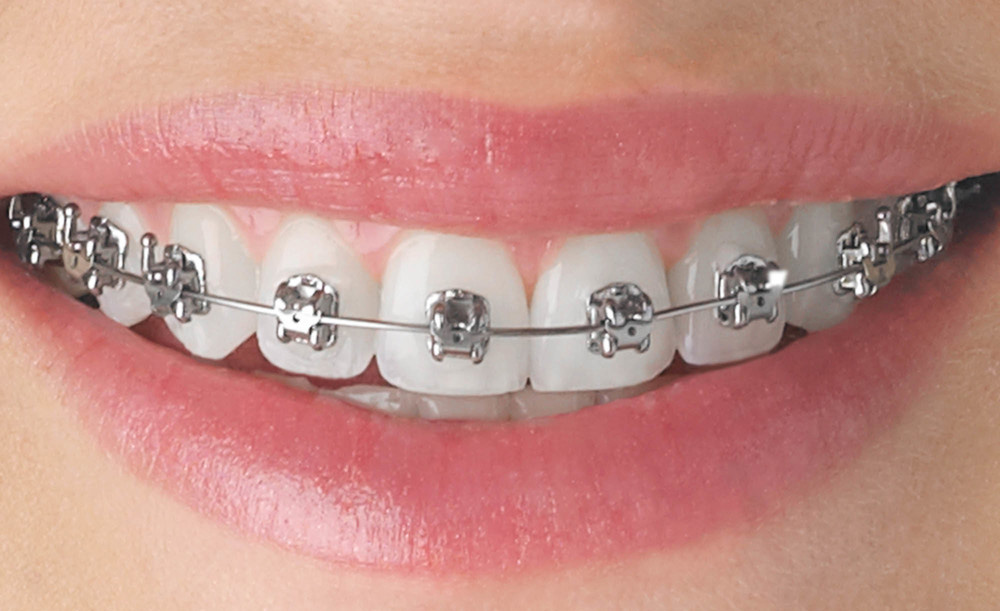 Silver braces