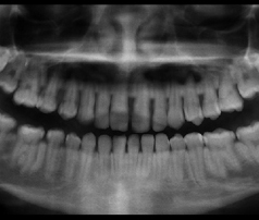 Panoramic X-ray